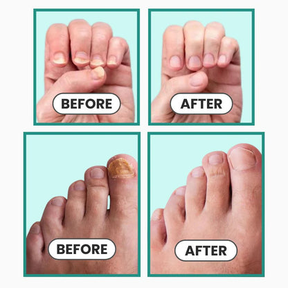 Auroxen Anti-Fungal Nail Treatment Device